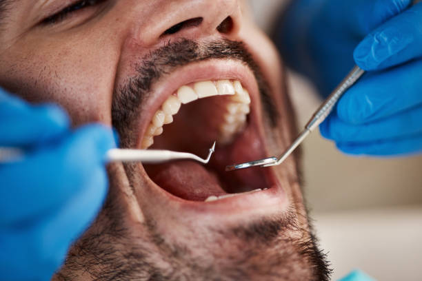 Best Emergency Dentist for Lost Fillings or Crowns in Reisterstown, MD